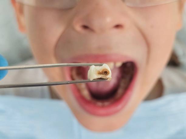 Best Pediatric Emergency Dentist in Wilkesboro, NC