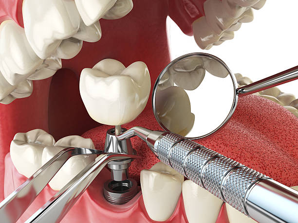 Best Emergency Dental Care for Abscessed Tooth in Wilkesboro, NC